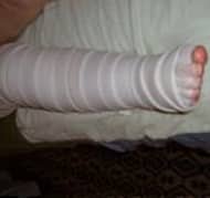 bandaging-image